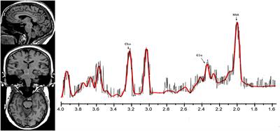 Increased Absolute Glutamate Concentrations and Glutamate-to-Creatine Ratios in Patients With Methamphetamine Use Disorders